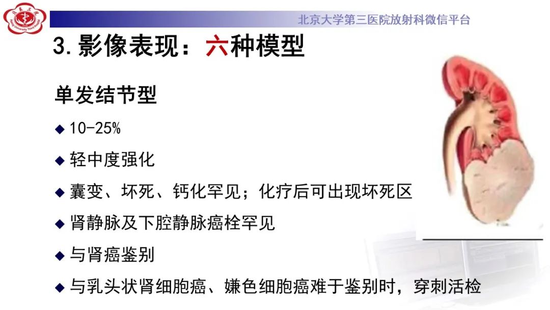 影像PPT - 【PPT】肾脏淋巴瘤-26