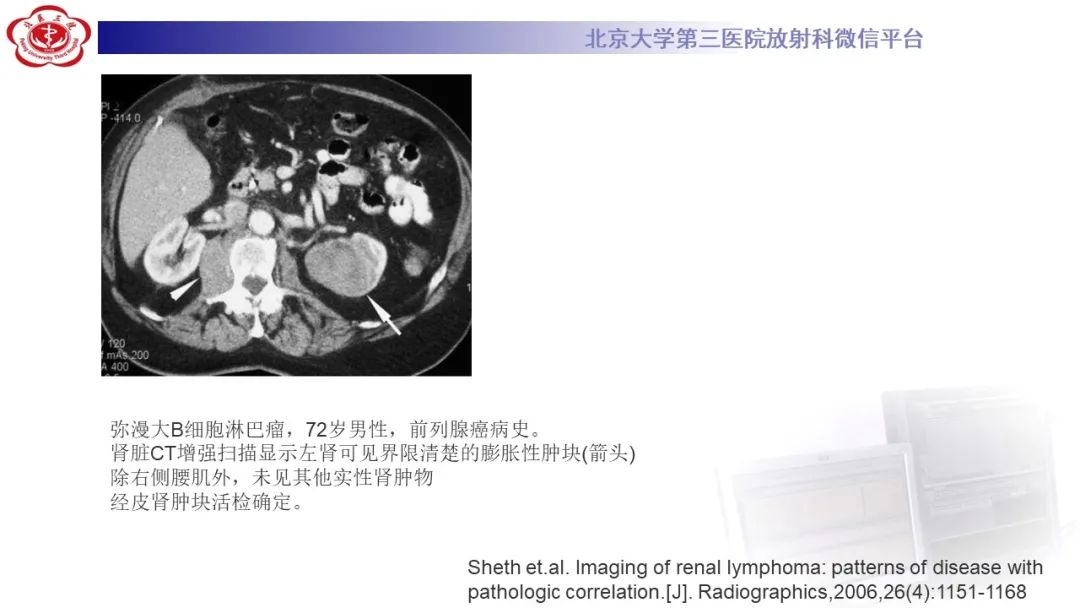 影像PPT - 【PPT】肾脏淋巴瘤-27