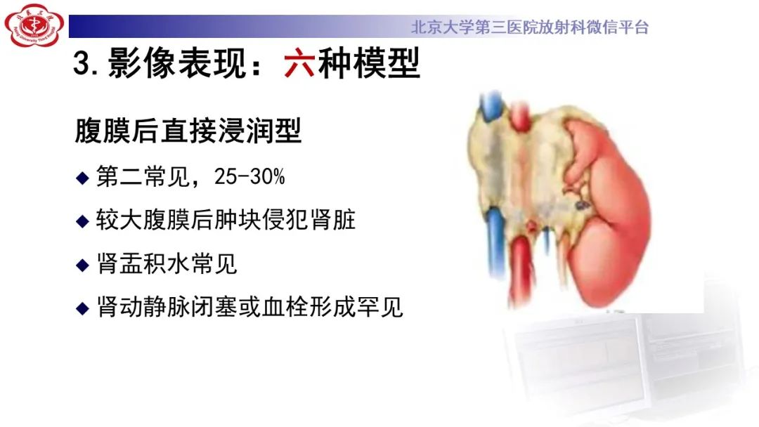影像PPT - 【PPT】肾脏淋巴瘤-28