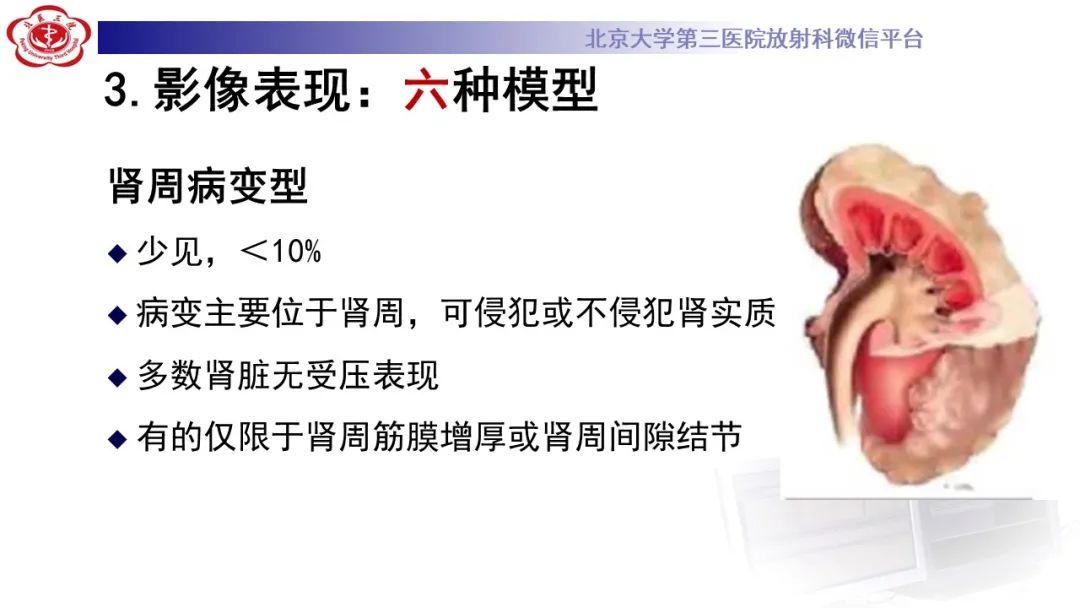影像PPT - 【PPT】肾脏淋巴瘤-30