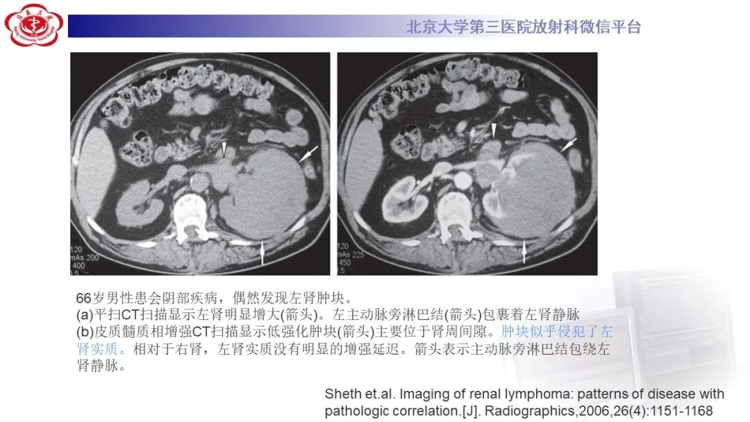 影像PPT - 【PPT】肾脏淋巴瘤-31