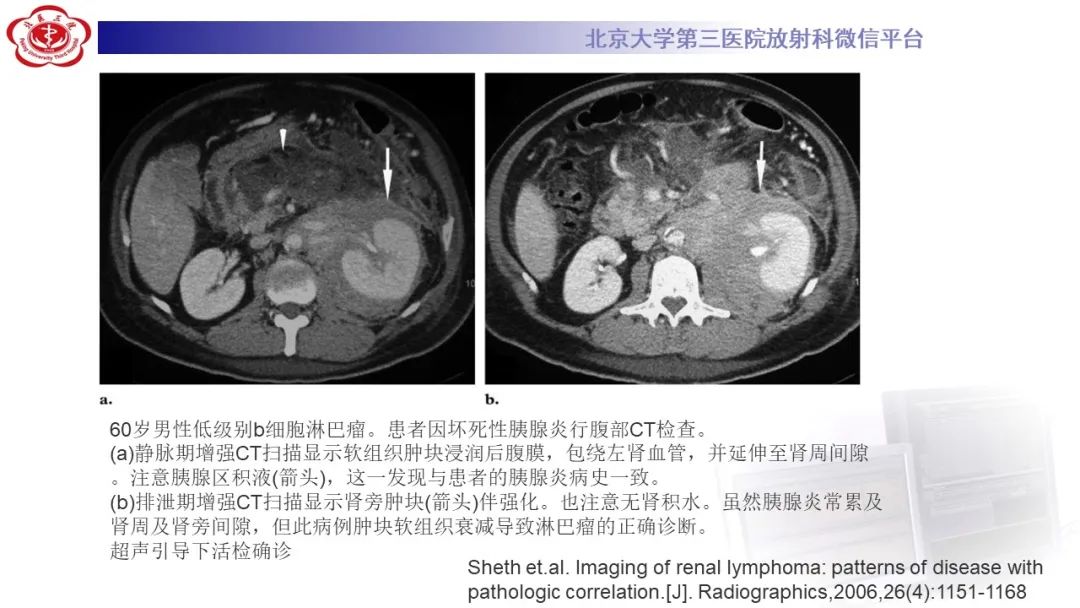 影像PPT - 【PPT】肾脏淋巴瘤-29