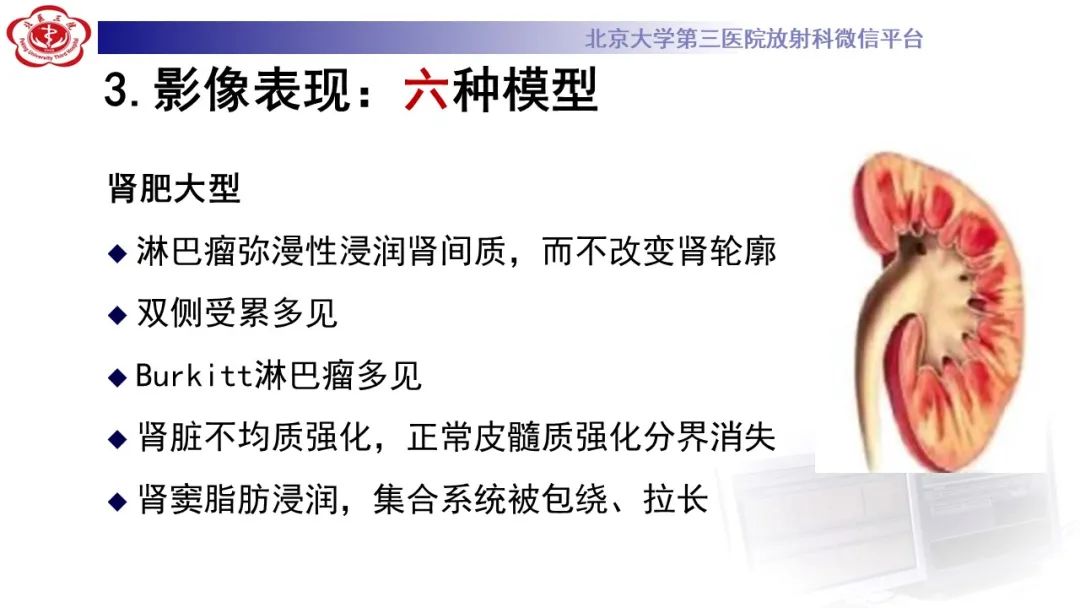 影像PPT - 【PPT】肾脏淋巴瘤-32