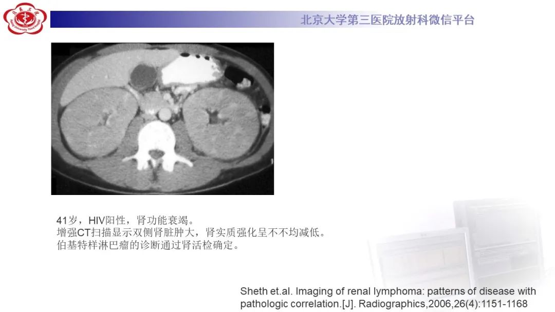 影像PPT - 【PPT】肾脏淋巴瘤-33