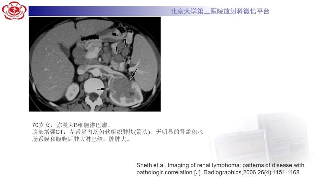 影像PPT - 【PPT】肾脏淋巴瘤-35