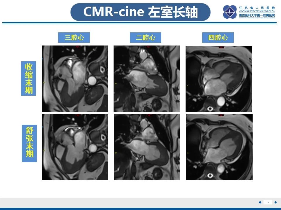 影像PPT - 【PPT】Löffler‘s心内膜炎-6
