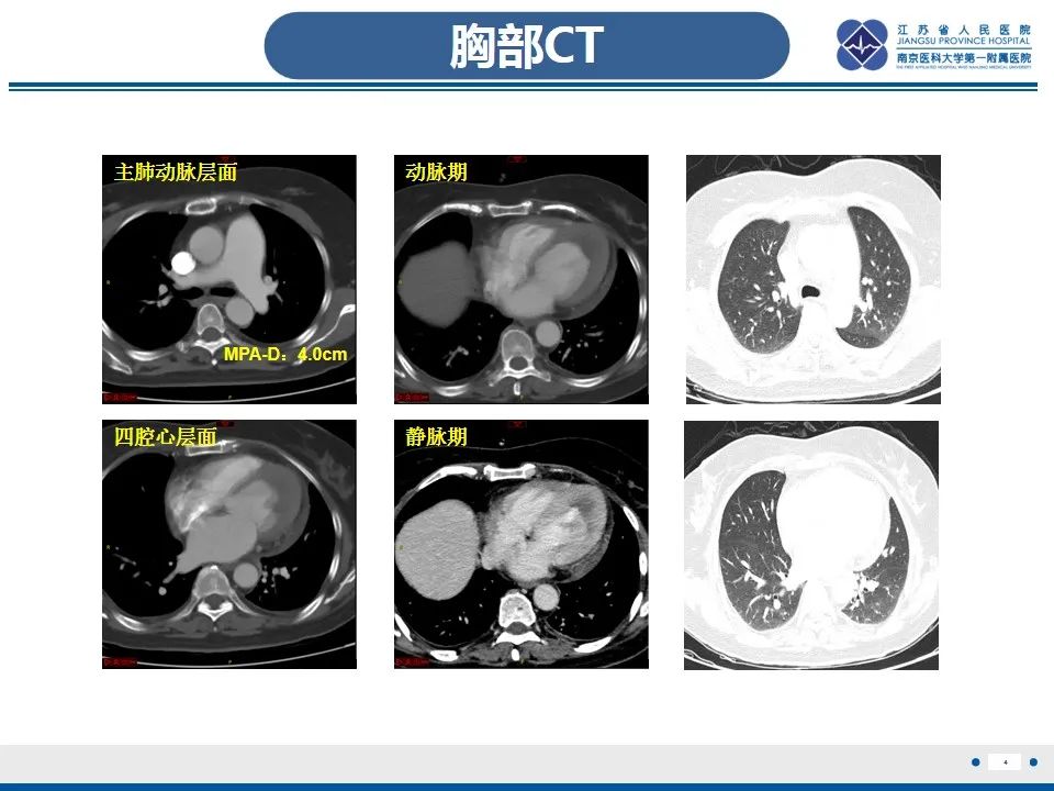 影像PPT - 【PPT】Löffler‘s心内膜炎-5