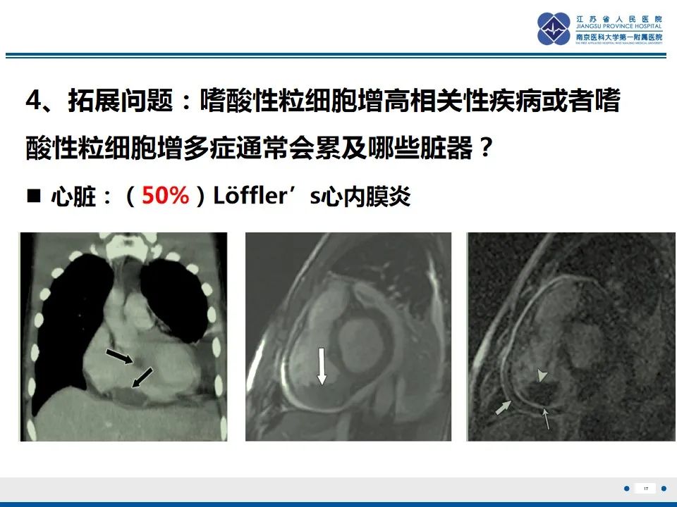 影像PPT - 【PPT】Löffler‘s心内膜炎-18
