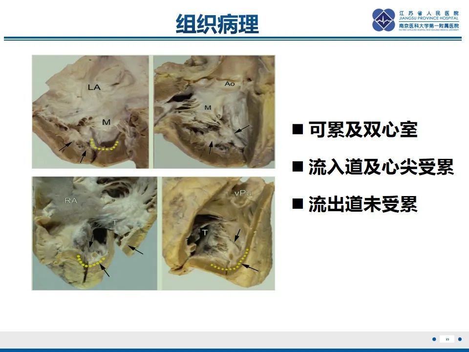 影像PPT - 【PPT】Löffler‘s心内膜炎-24