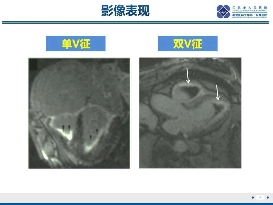 影像PPT - 【PPT】Löffler‘s心内膜炎-26