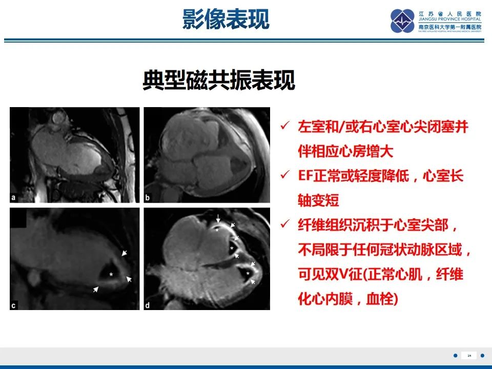 影像PPT - 【PPT】Löffler‘s心内膜炎-25
