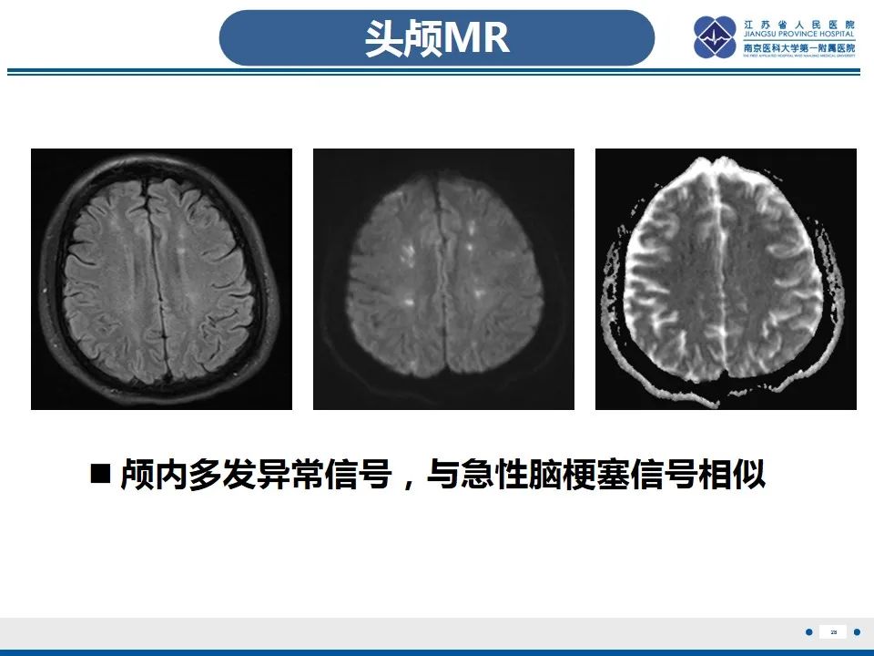 影像PPT - 【PPT】Löffler‘s心内膜炎-29
