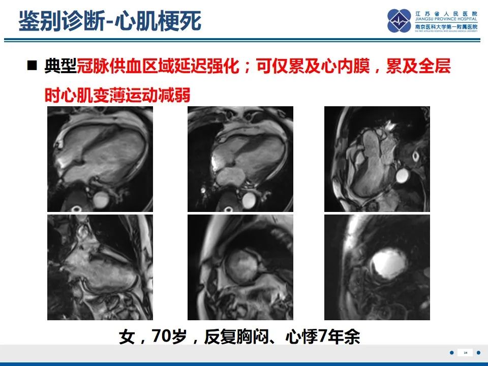 影像PPT - 【PPT】Löffler‘s心内膜炎-35