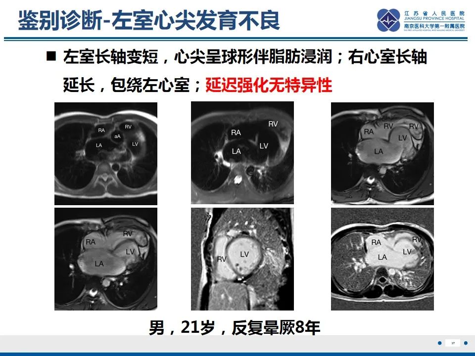 影像PPT - 【PPT】Löffler‘s心内膜炎-38