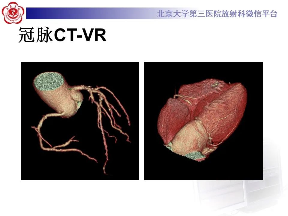 影像PPT - 【PPT】冠状动脉扩张-3
