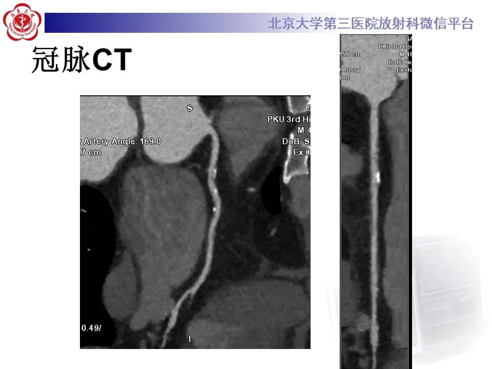 影像PPT - 【PPT】冠状动脉扩张-4