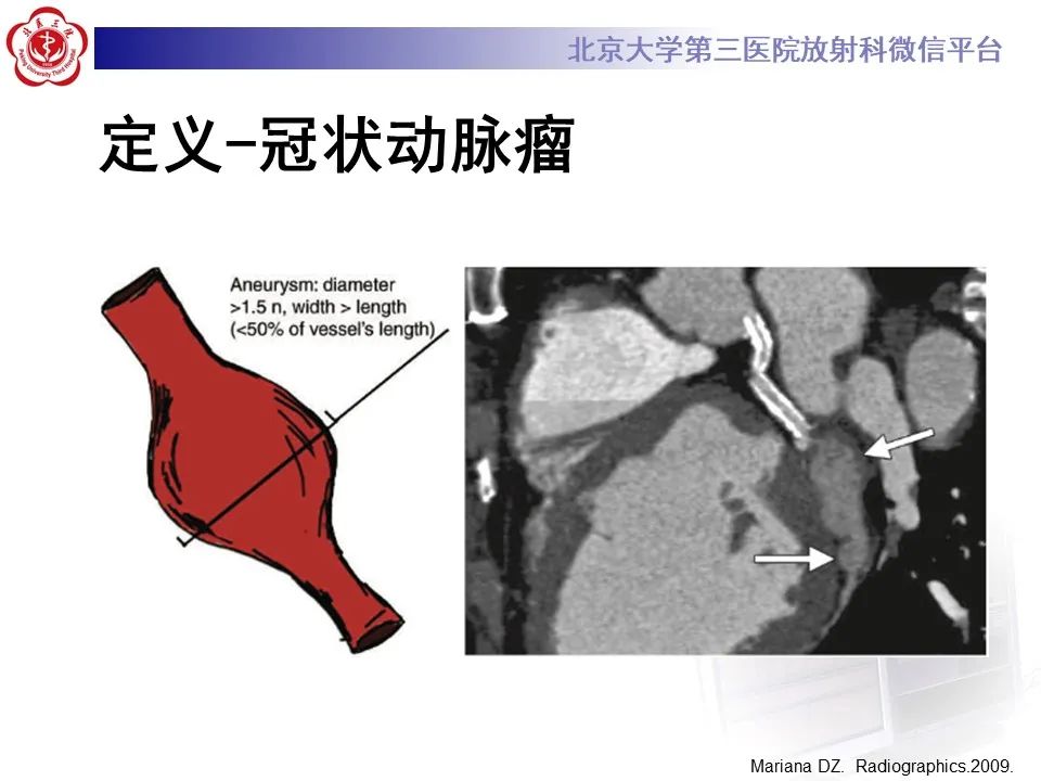 影像PPT - 【PPT】冠状动脉扩张-9