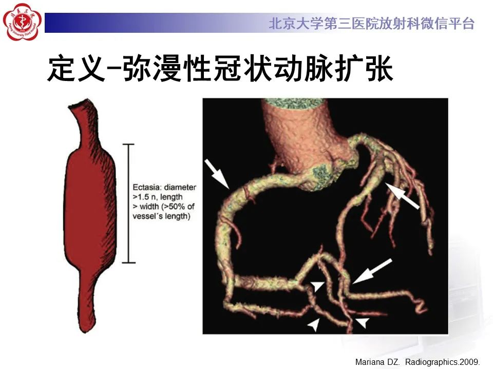影像PPT - 【PPT】冠状动脉扩张-10