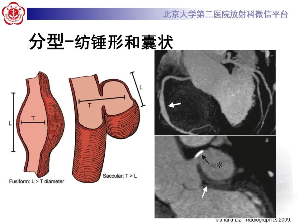 影像PPT - 【PPT】冠状动脉扩张-14
