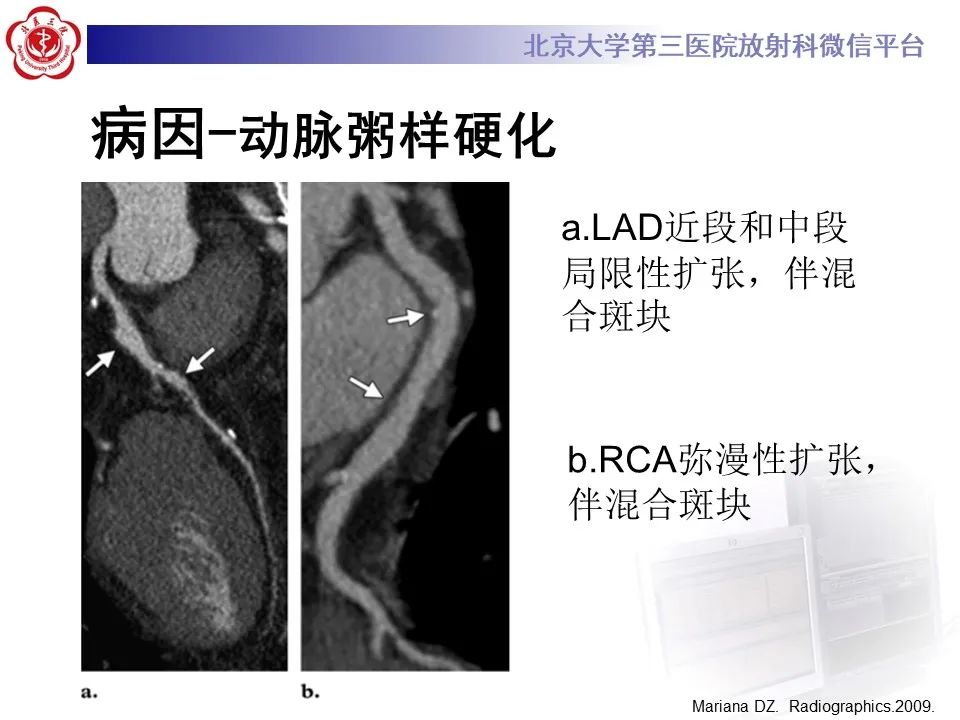影像PPT - 【PPT】冠状动脉扩张-19