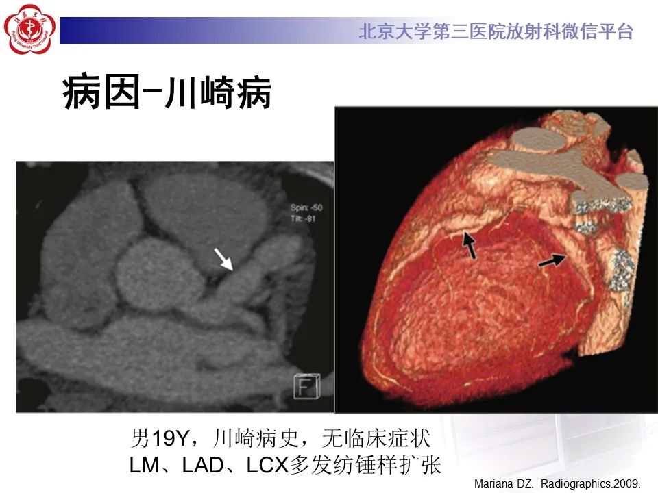 影像PPT - 【PPT】冠状动脉扩张-20