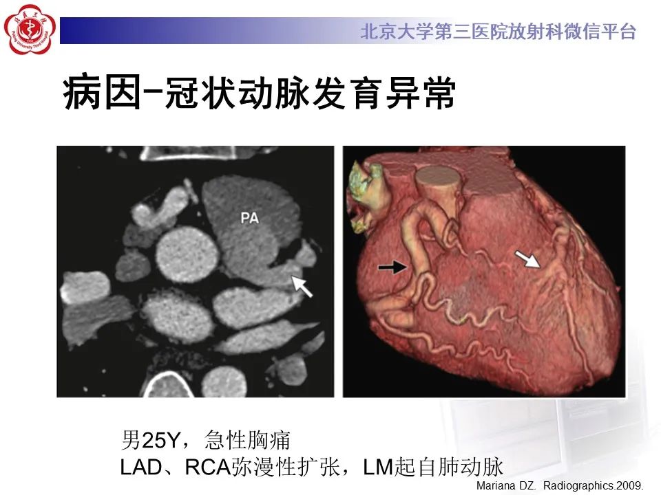 影像PPT - 【PPT】冠状动脉扩张-23