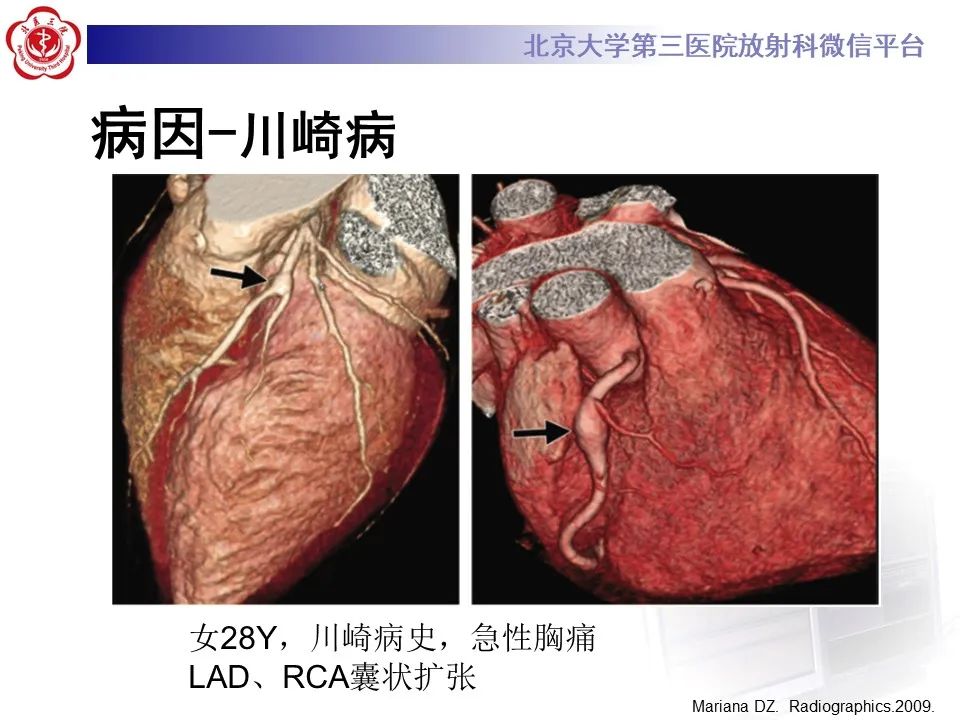 影像PPT - 【PPT】冠状动脉扩张-21