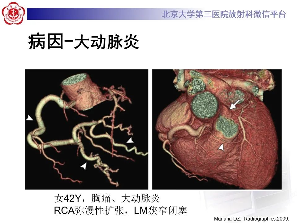 影像PPT - 【PPT】冠状动脉扩张-24