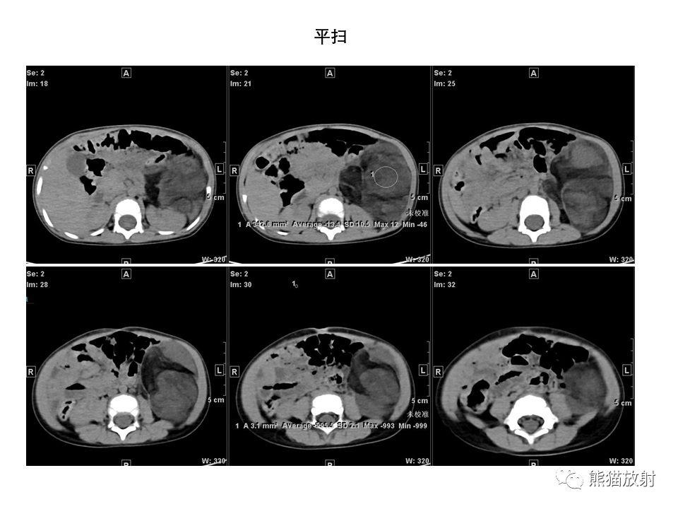影像PPT - 【病例】腹膜后脂肪肉瘤 VS 脂肪母细胞瘤-12