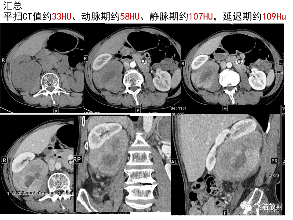 影像PPT - 【病例】腹膜后脂肪肉瘤 VS 脂肪母细胞瘤-9