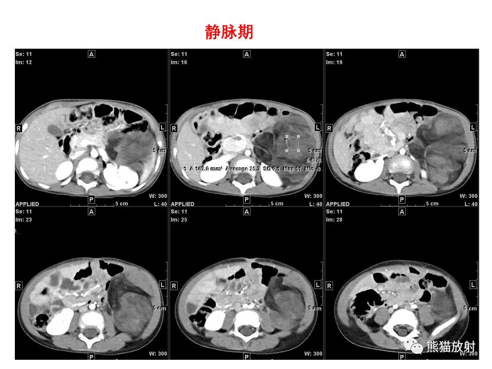 影像PPT - 【病例】腹膜后脂肪肉瘤 VS 脂肪母细胞瘤-14