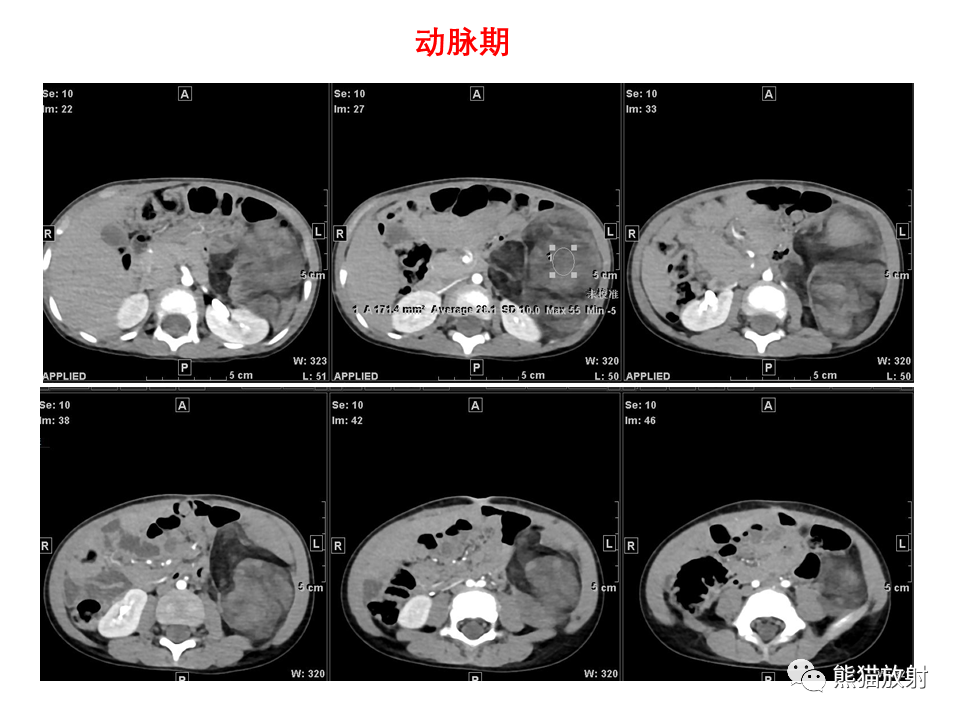 影像PPT - 【病例】腹膜后脂肪肉瘤 VS 脂肪母细胞瘤-13