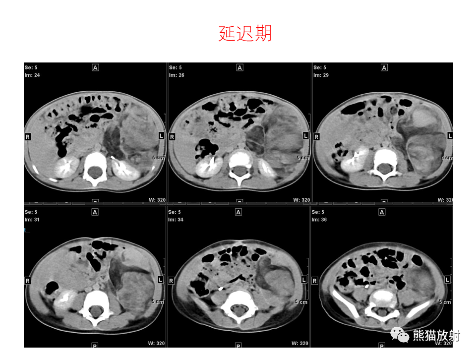影像PPT - 【病例】腹膜后脂肪肉瘤 VS 脂肪母细胞瘤-15