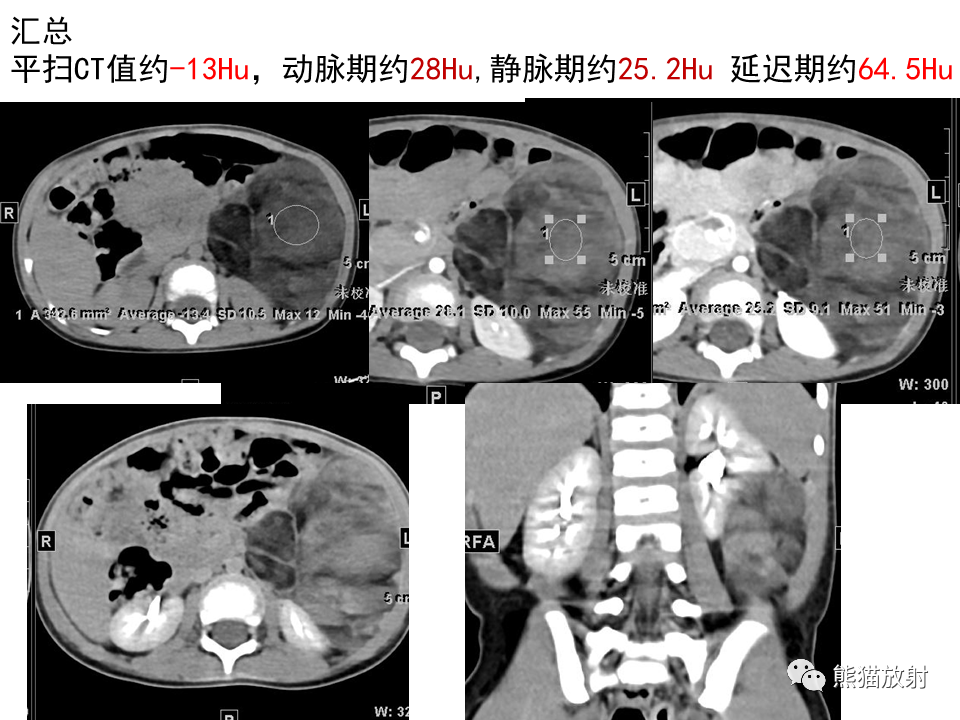 影像PPT - 【病例】腹膜后脂肪肉瘤 VS 脂肪母细胞瘤-17