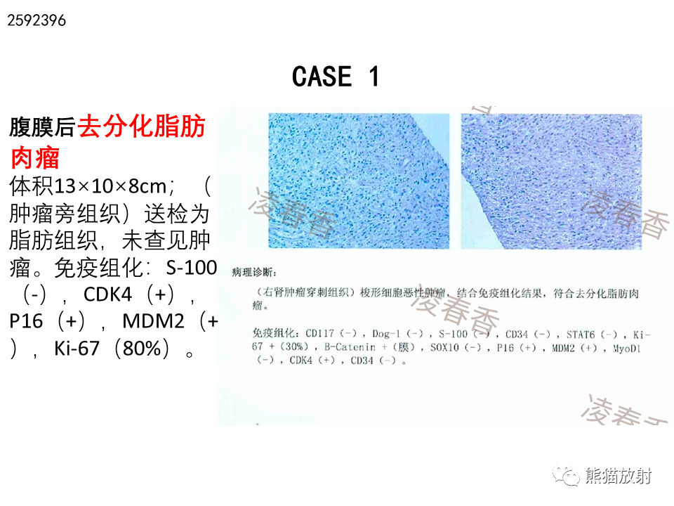 影像PPT - 【病例】腹膜后脂肪肉瘤 VS 脂肪母细胞瘤-19