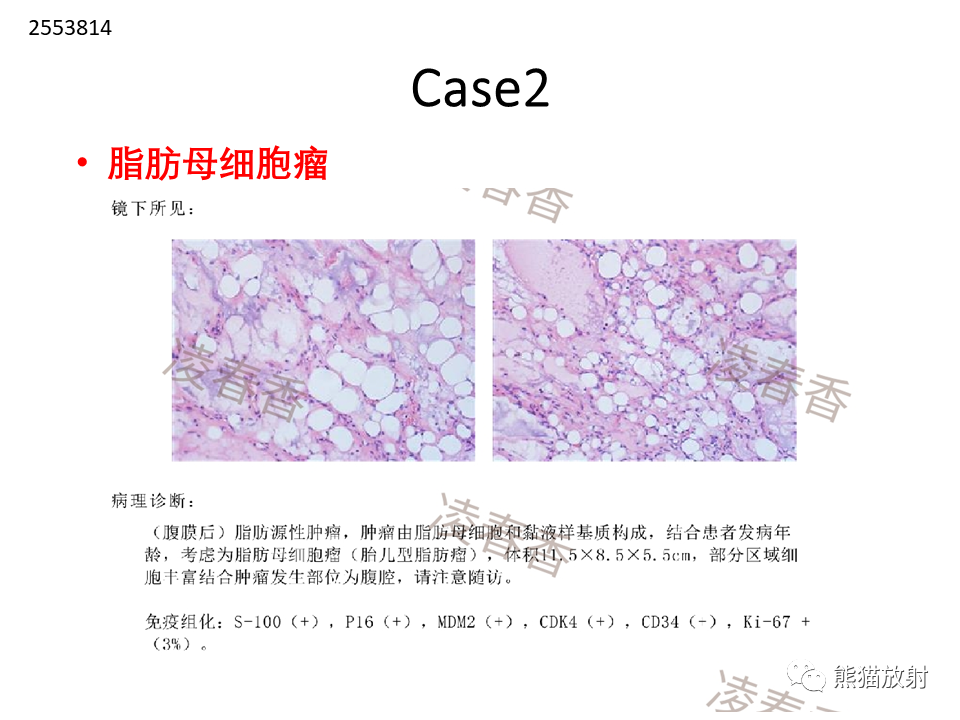 影像PPT - 【病例】腹膜后脂肪肉瘤 VS 脂肪母细胞瘤-20