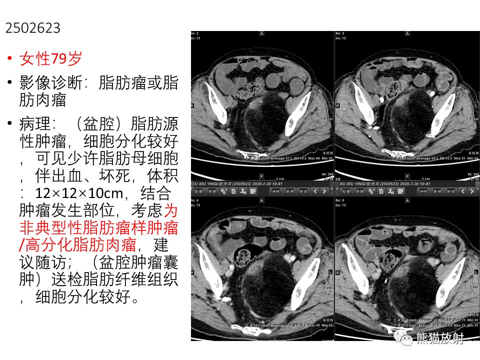 影像PPT - 【病例】腹膜后脂肪肉瘤 VS 脂肪母细胞瘤-28