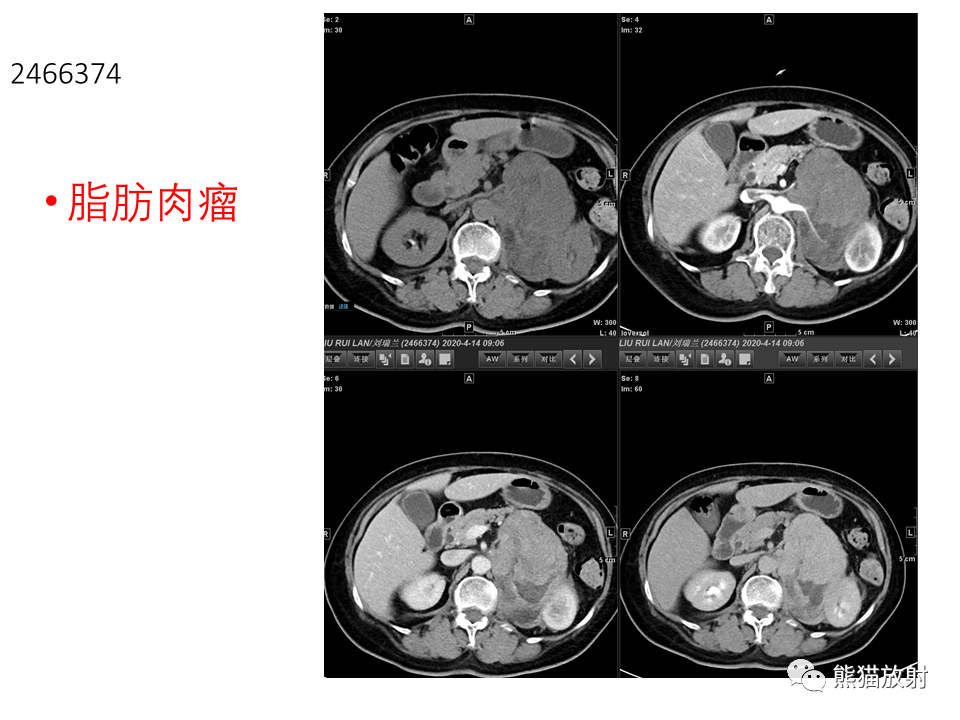 影像PPT - 【病例】腹膜后脂肪肉瘤 VS 脂肪母细胞瘤-29