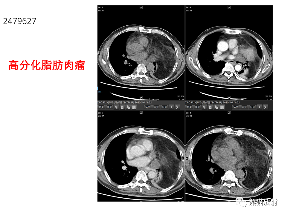 影像PPT - 【病例】腹膜后脂肪肉瘤 VS 脂肪母细胞瘤-30