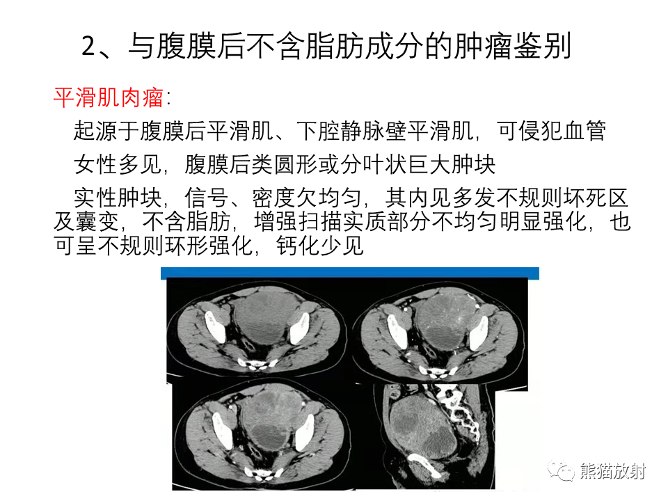 影像PPT - 【病例】腹膜后脂肪肉瘤 VS 脂肪母细胞瘤-33