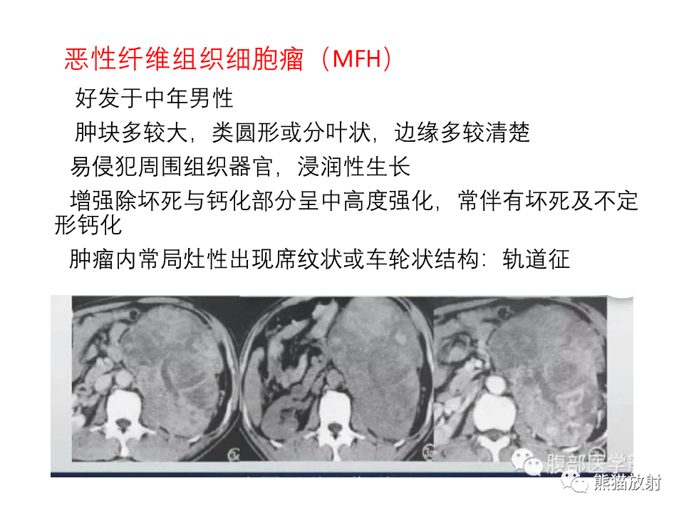 影像PPT - 【病例】腹膜后脂肪肉瘤 VS 脂肪母细胞瘤-34