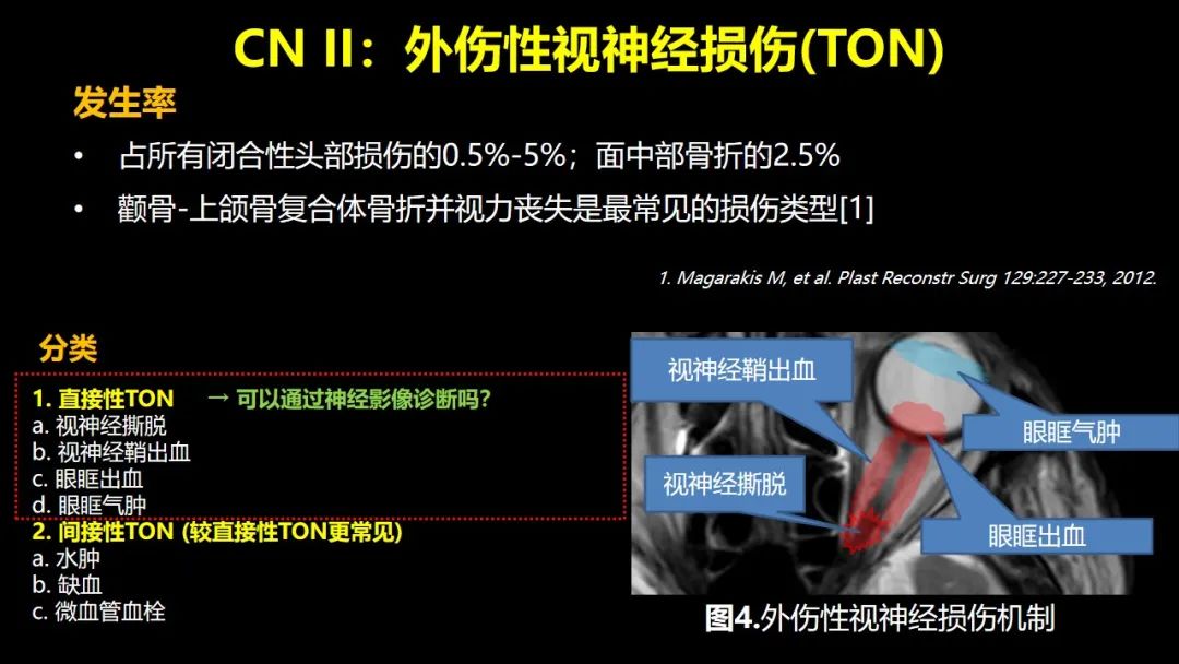 影像PPT - 【PPT】创伤性颅神经损伤的影像表现-13