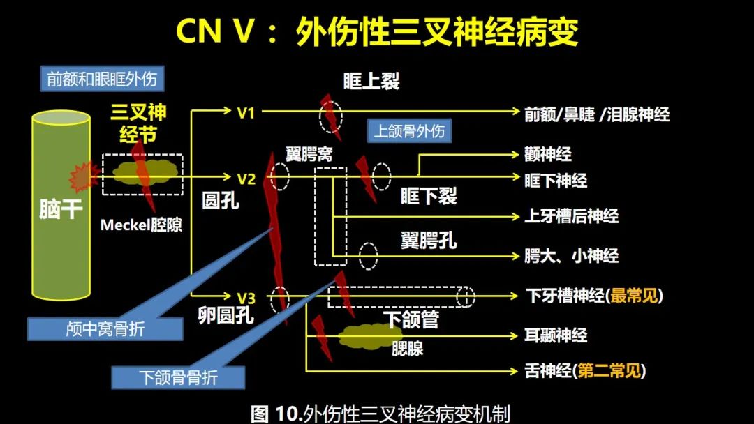 影像PPT - 【PPT】创伤性颅神经损伤的影像表现-23