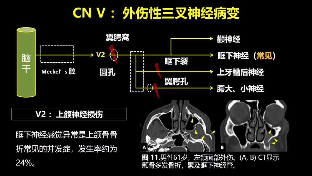 影像PPT - 【PPT】创伤性颅神经损伤的影像表现-27