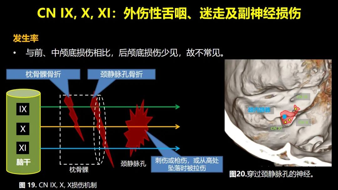 影像PPT - 【PPT】创伤性颅神经损伤的影像表现-41
