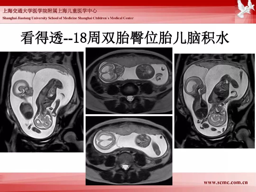 影像PPT - 【PPT】胎儿磁共振检查技术-17