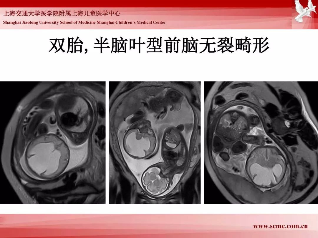 影像PPT - 【PPT】胎儿磁共振检查技术-18