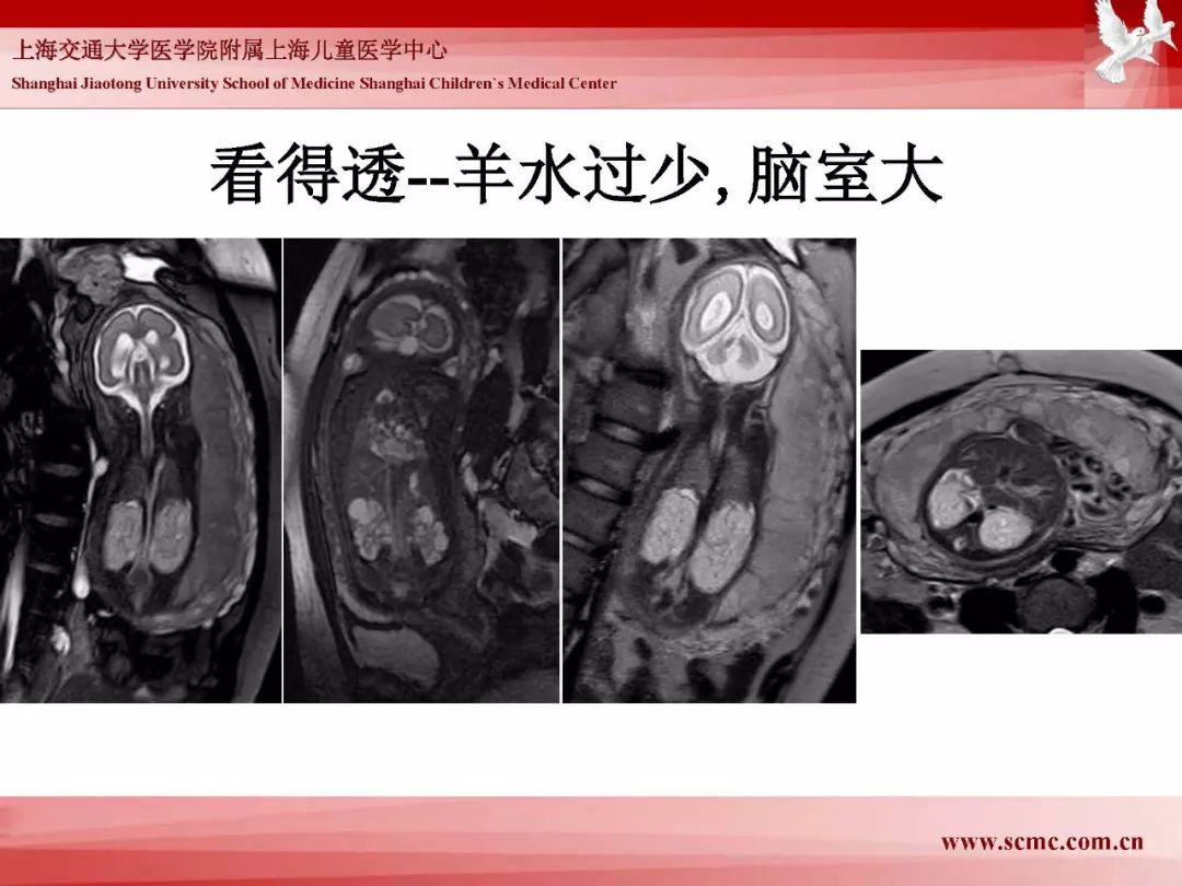影像PPT - 【PPT】胎儿磁共振检查技术-20