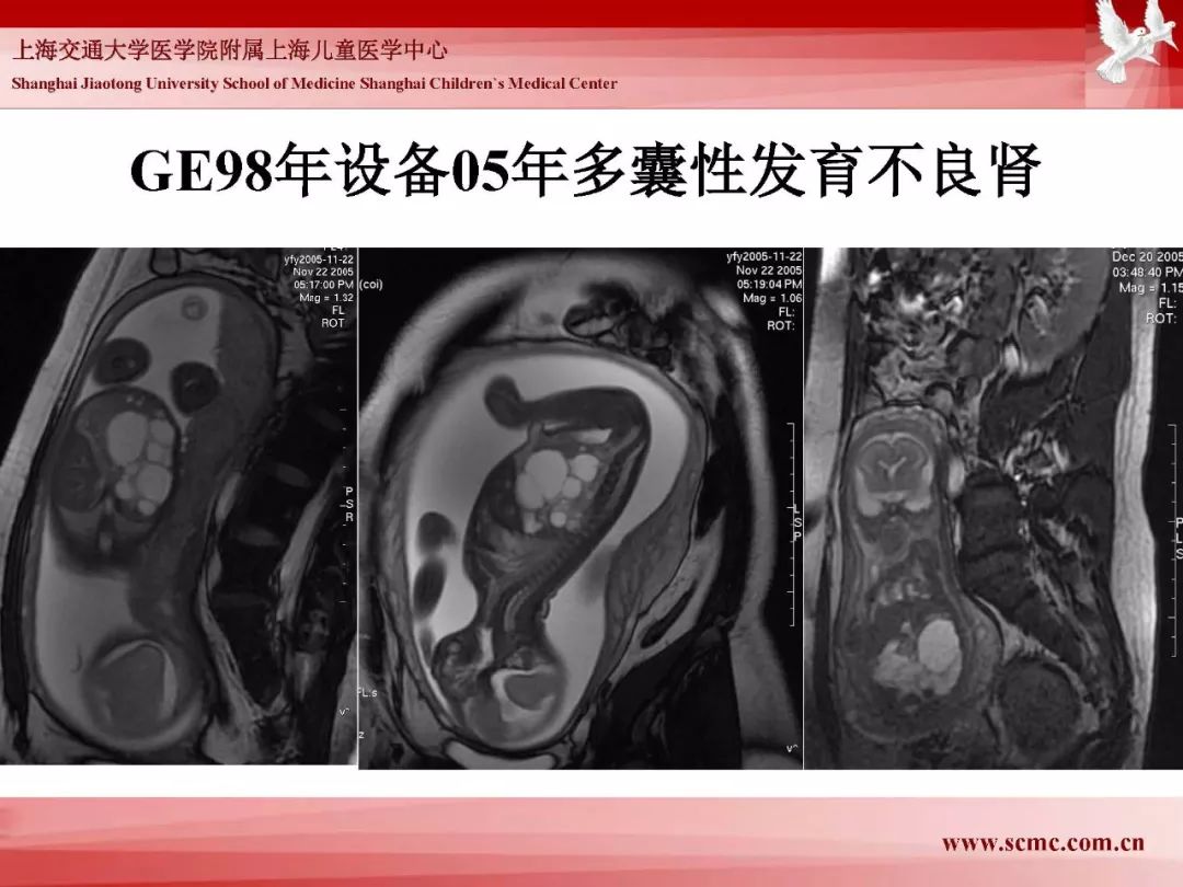 影像PPT - 【PPT】胎儿磁共振检查技术-21