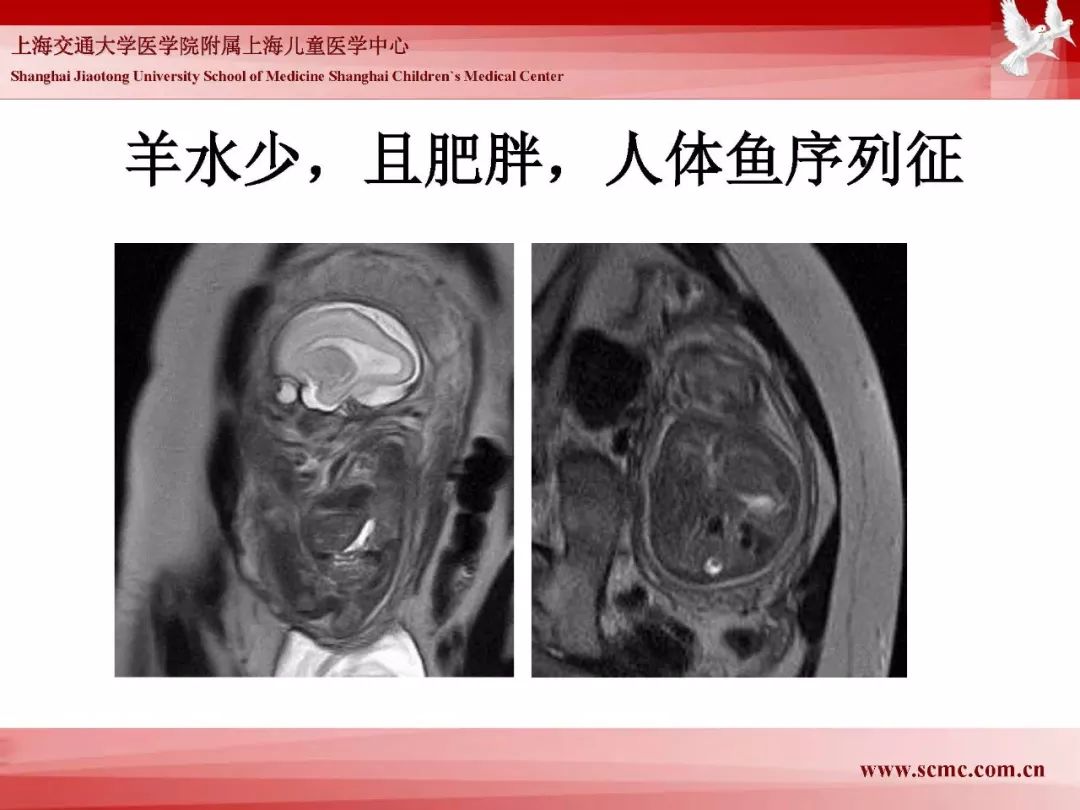 影像PPT - 【PPT】胎儿磁共振检查技术-22